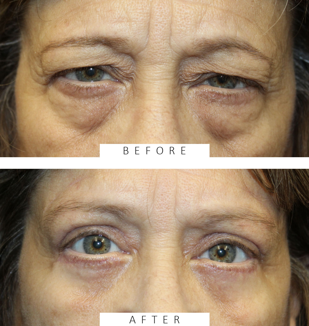 Direct brow ptosis repair, external ptosis repair, lower eyelid blepharoplasty with canthopexy