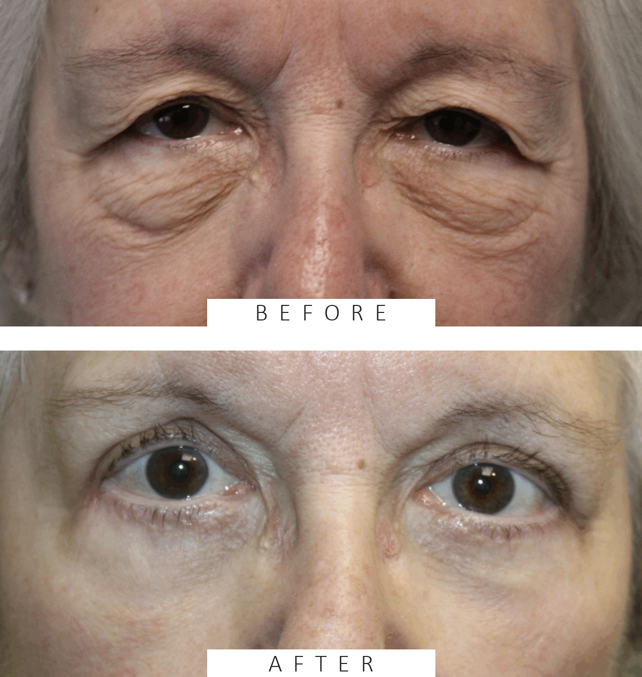 Upper and Lower blepharoplasty with TCA Peel