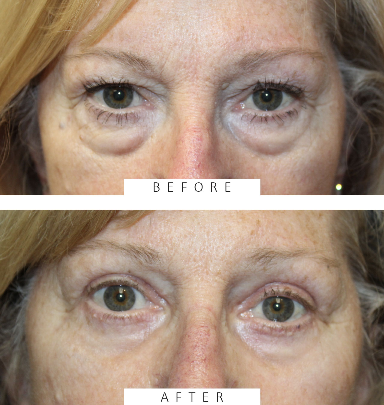 Upper and Lower Eyelid Blepharoplasty with TCA Peel