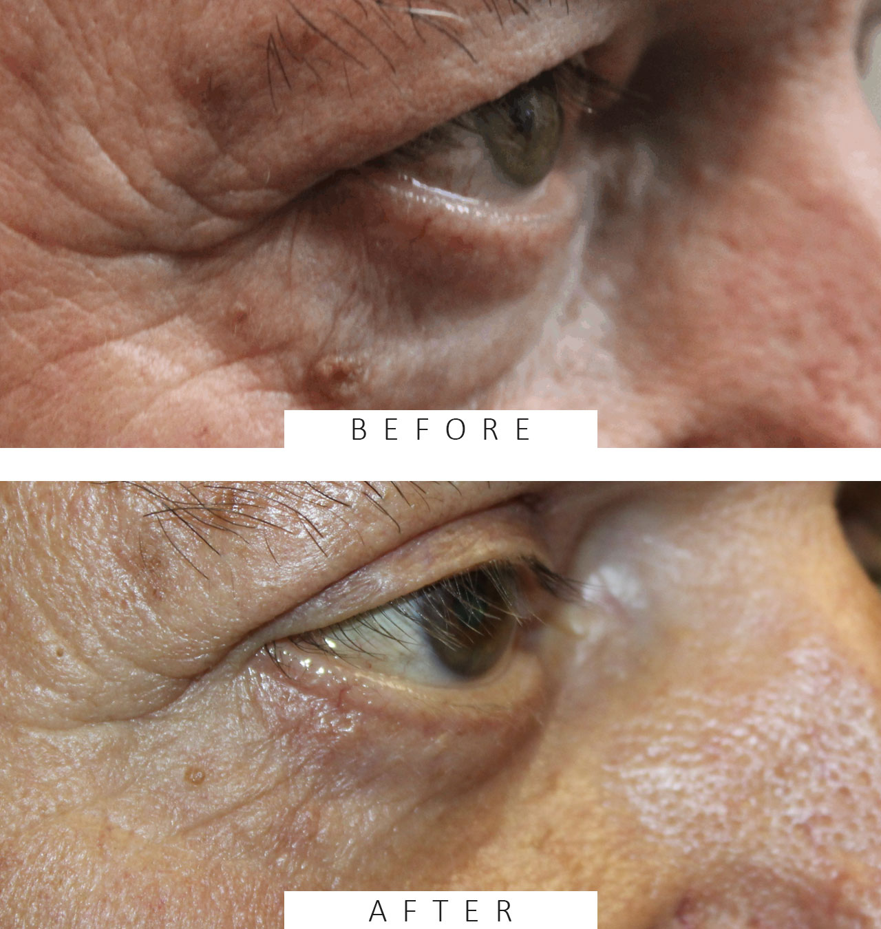 Upper and Lower Eyelid Blepharoplasty with Lower Eyelid Fat Transposition
