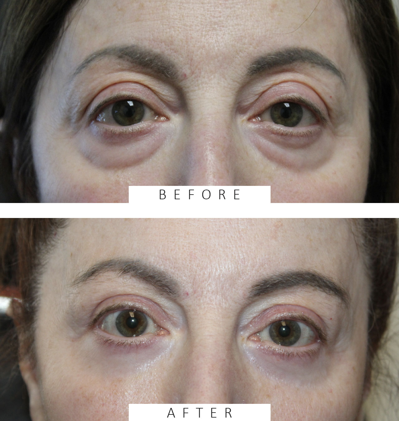 Upper and Lower Eyelid Blepharoplasty with TCA Peel and Canthopexy