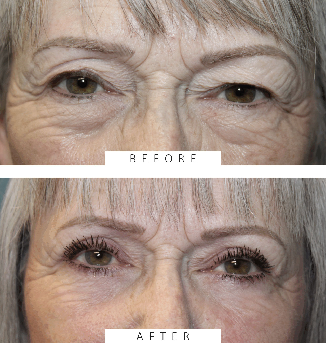 Upper and Lower Blepharoplasty with TCA Peel and Canthopexy