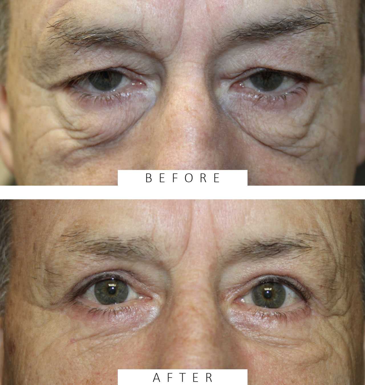 Upper and Lower Eyelid Blepharoplasty and Upper Eyelid Ptosis Repair.