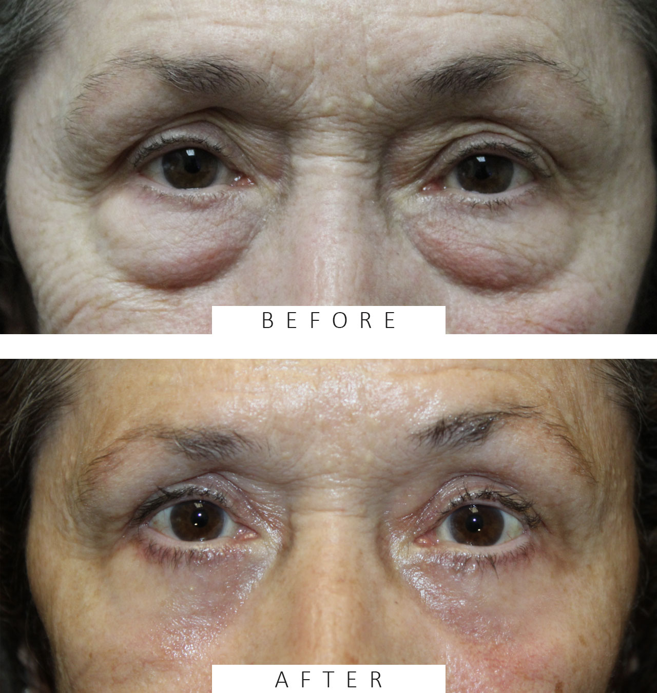 Upper and Lower Blepharoplasty with TCA Peel