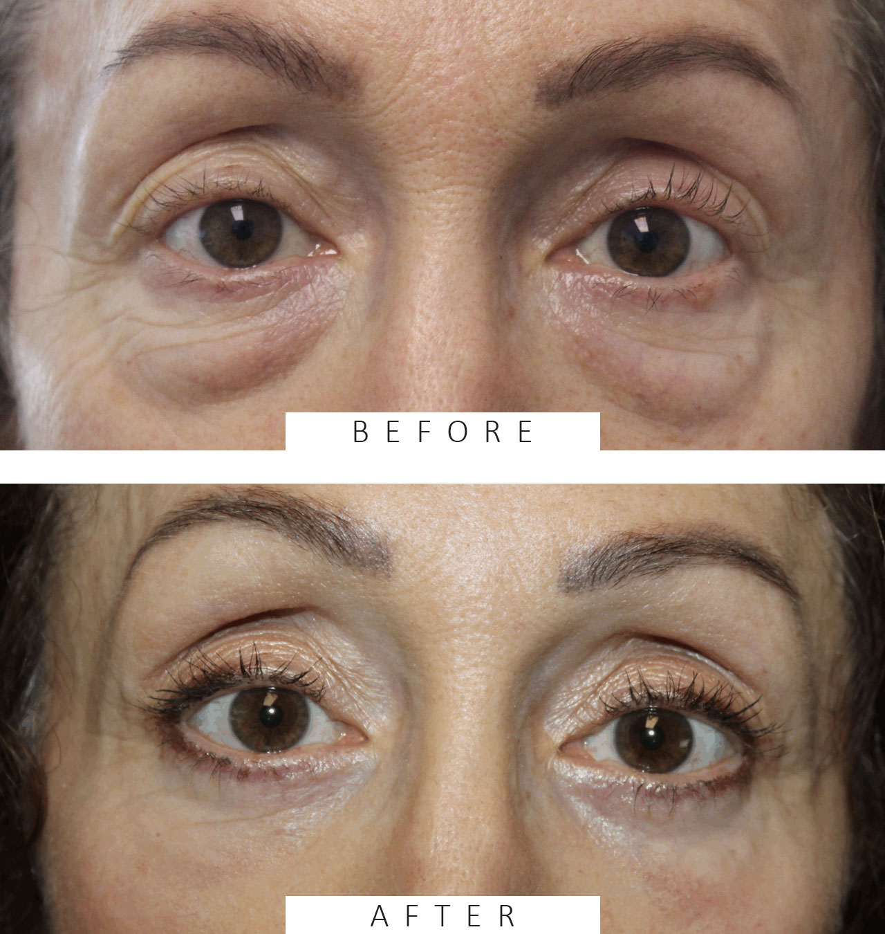 Lower Blepharoplasty and TCA Peel