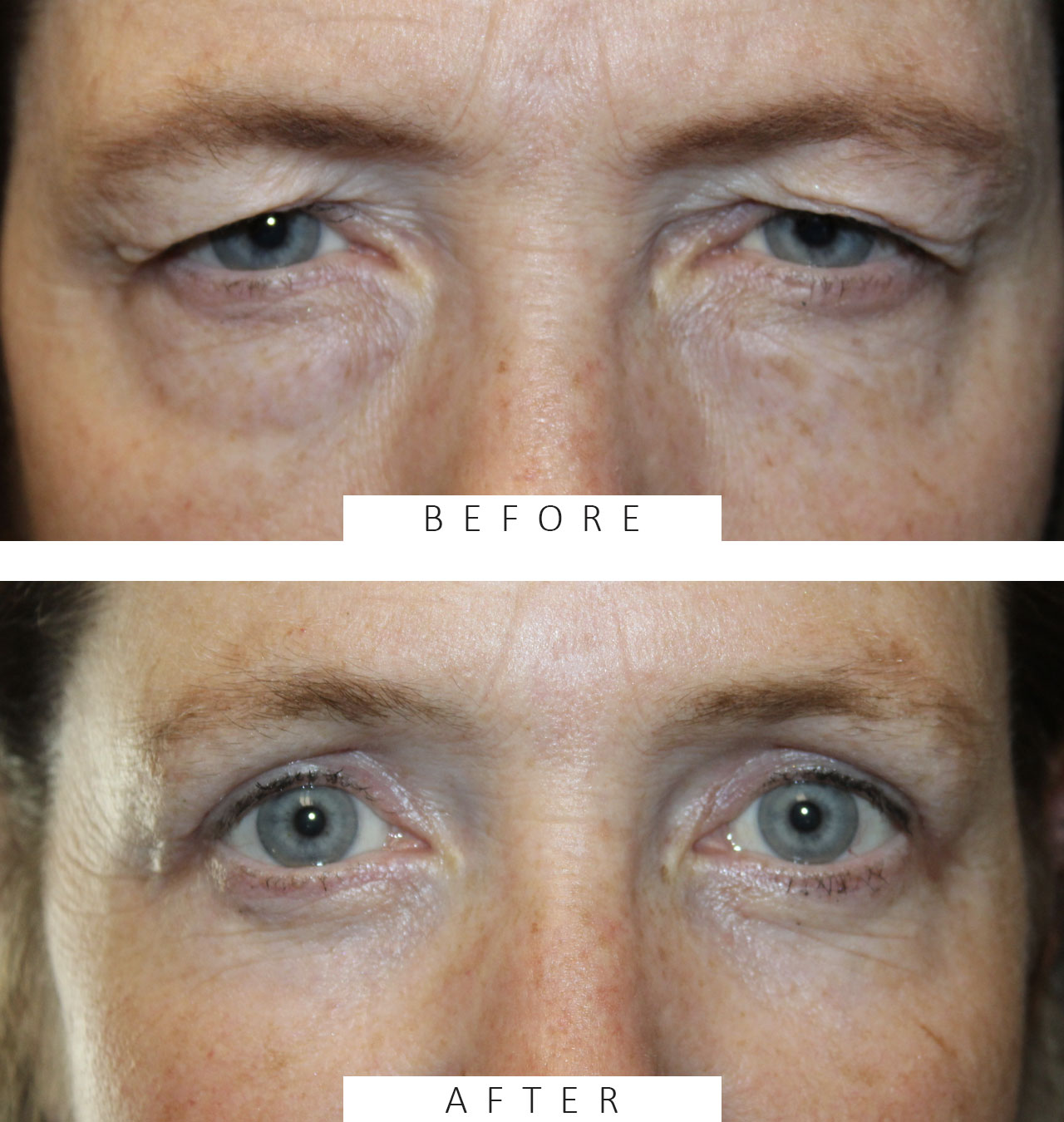 Upper and Lower Blepharoplasty with TCA Peel and Canthopexy