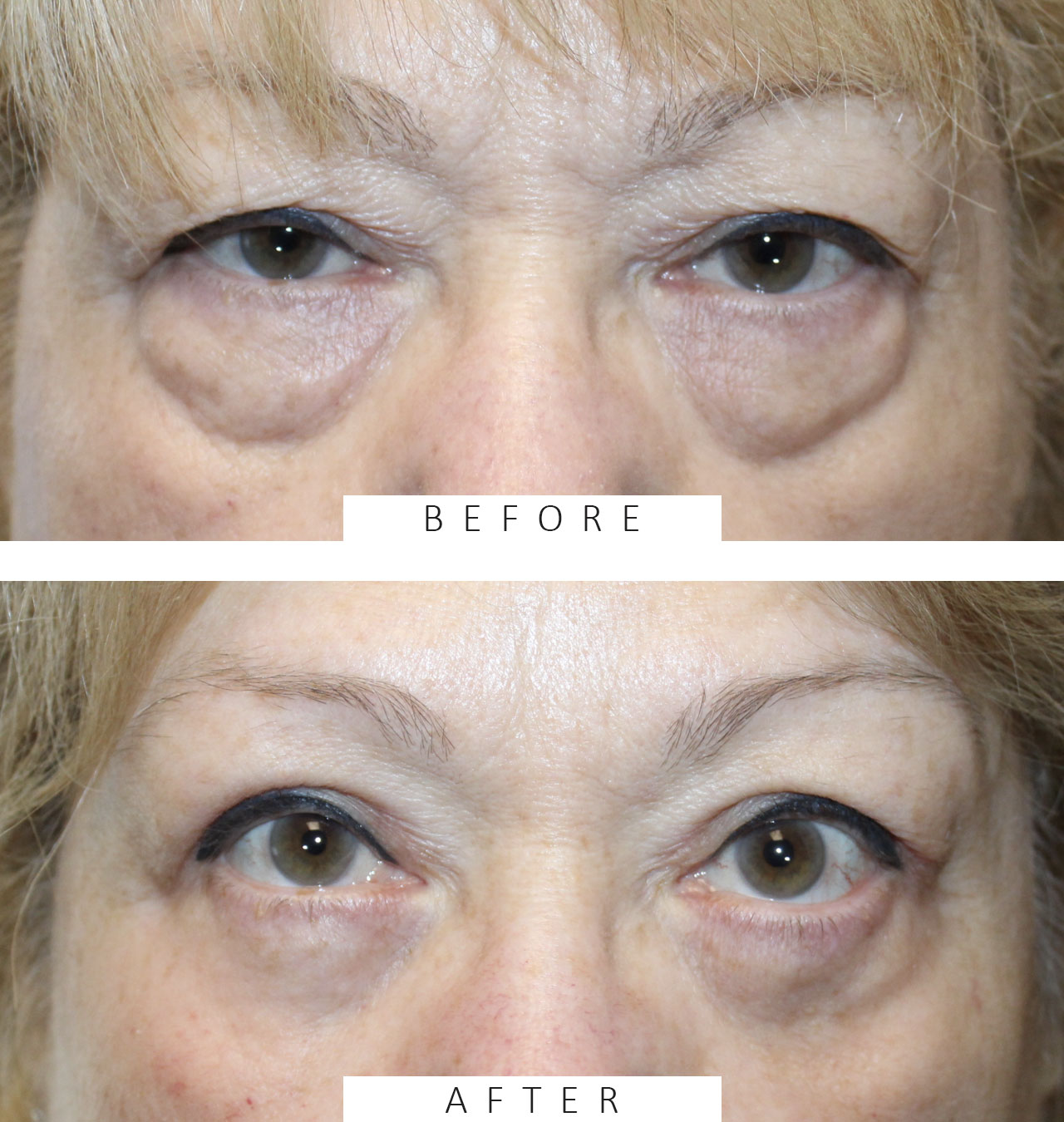 Upper and Lower Blepharoplasty, Internal Ptosis Repair, and TCA Peel