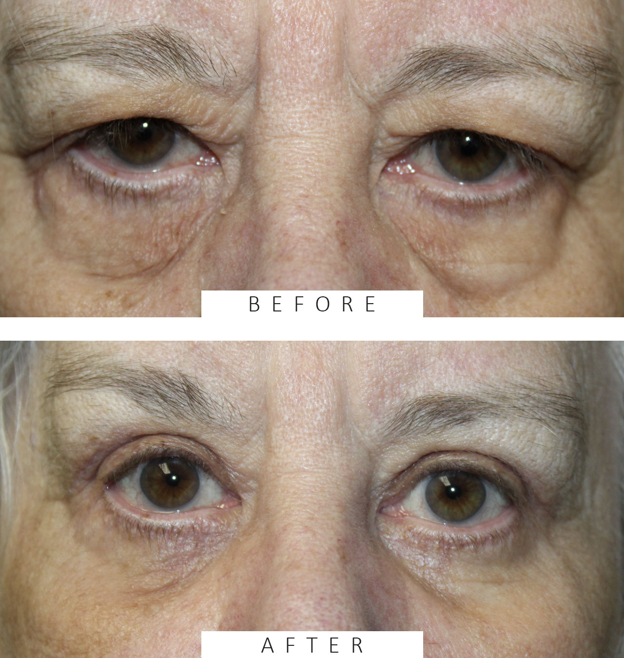 Upper and Lower Blepharoplasty