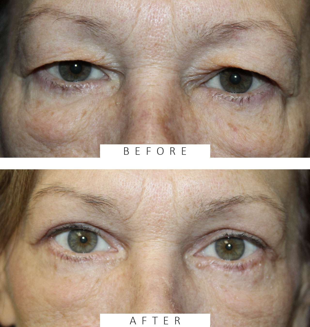 Upper and Lower Blepharoplasty with TCA Peel