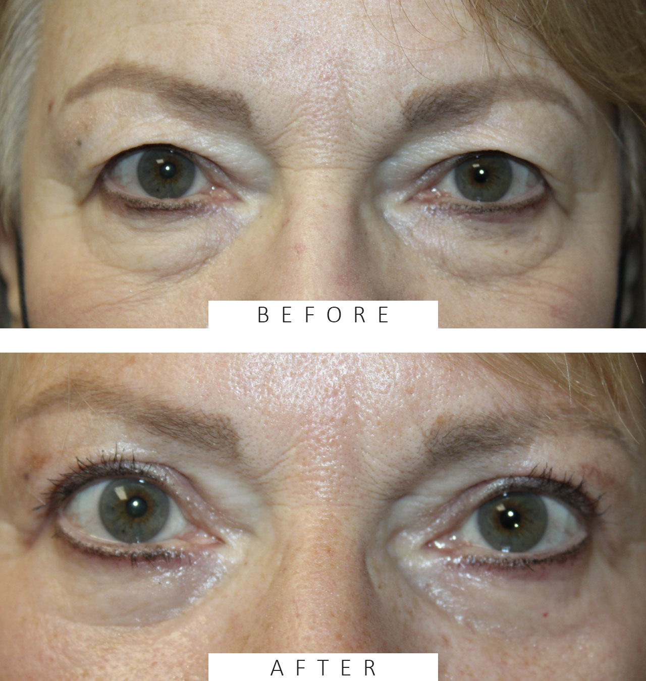 Upper and Lower Blepharoplasty with TCA peel