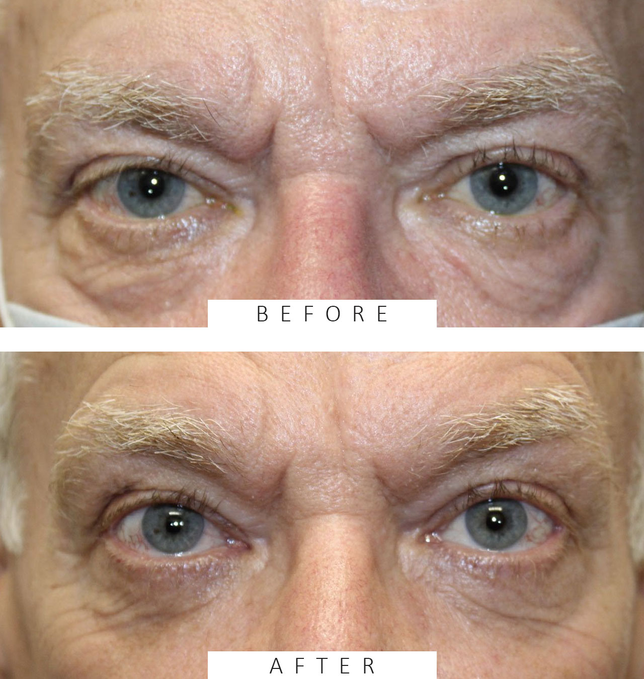Lower Blepharoplasty, Canthopexy and TCA Peel