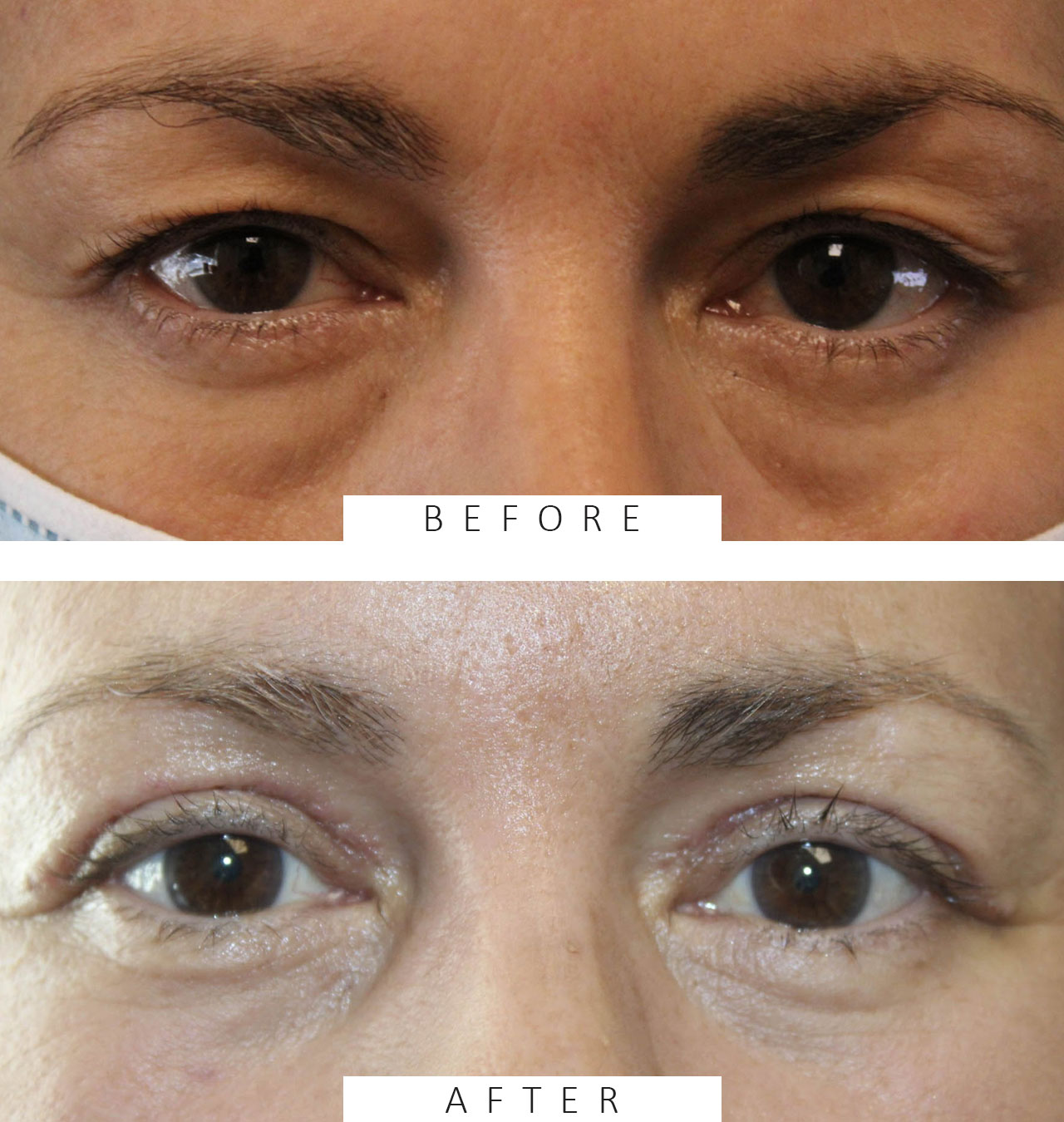 Upper and Lower Blepharoplasty