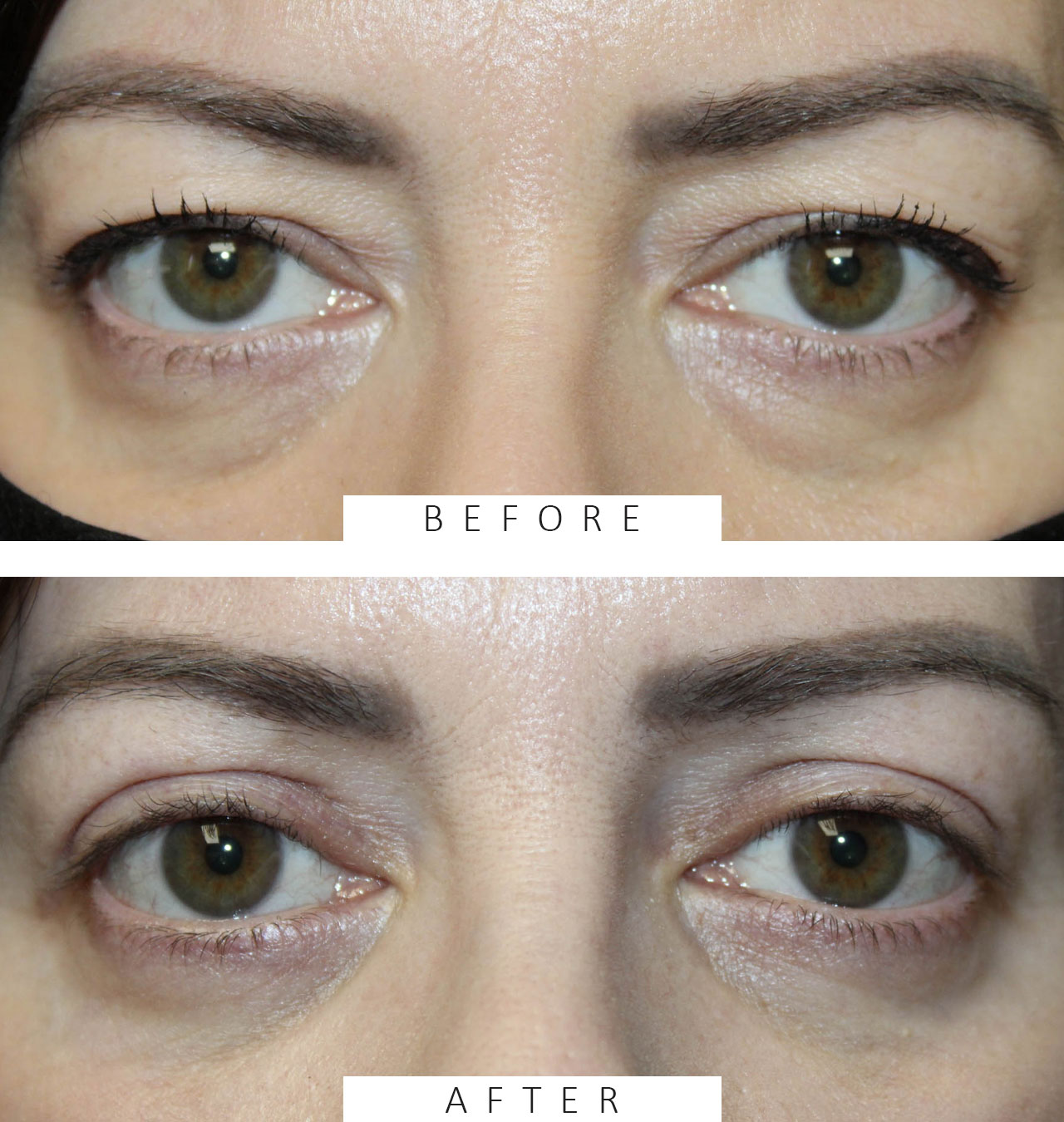 Upper & Lower Blepharoplasty with TCA peel