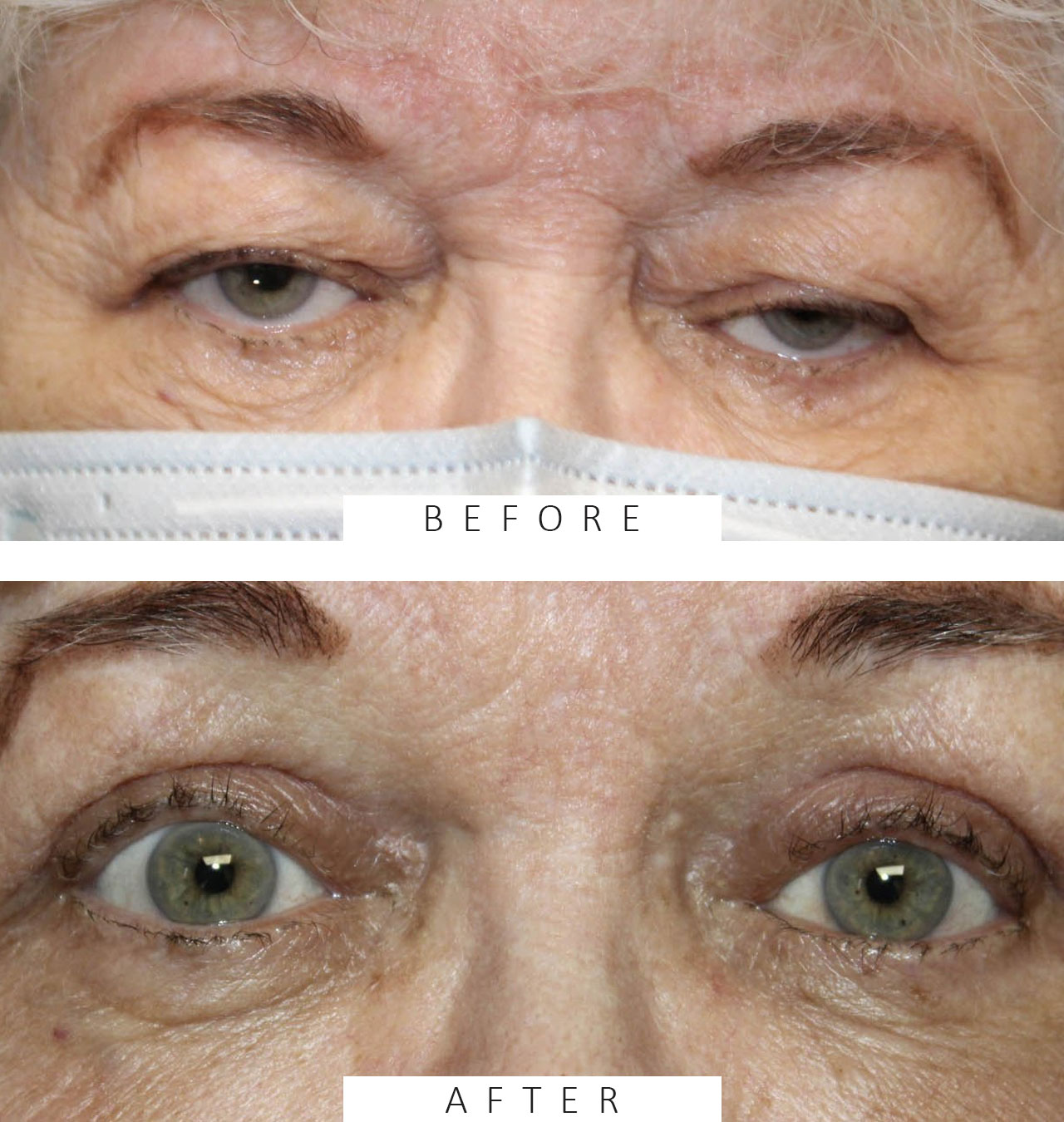 Upper Eyelid External Ptosis Repair