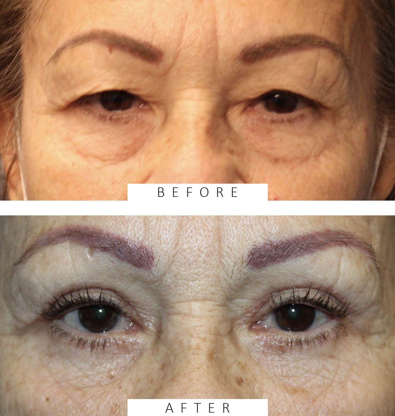 Upper & Lower Blepharoplasty with TCA peel