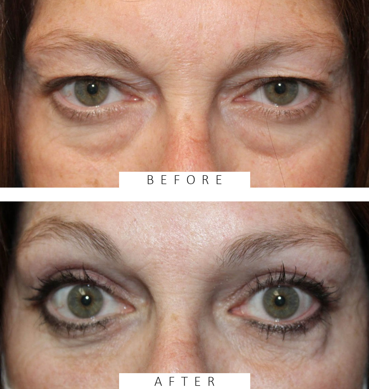Upper & Lower Blepharoplasty