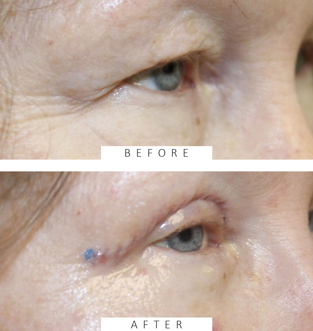 Upper & Lower Blepharoplasty with Lower Eyelid TCA Peel - After 1 Week