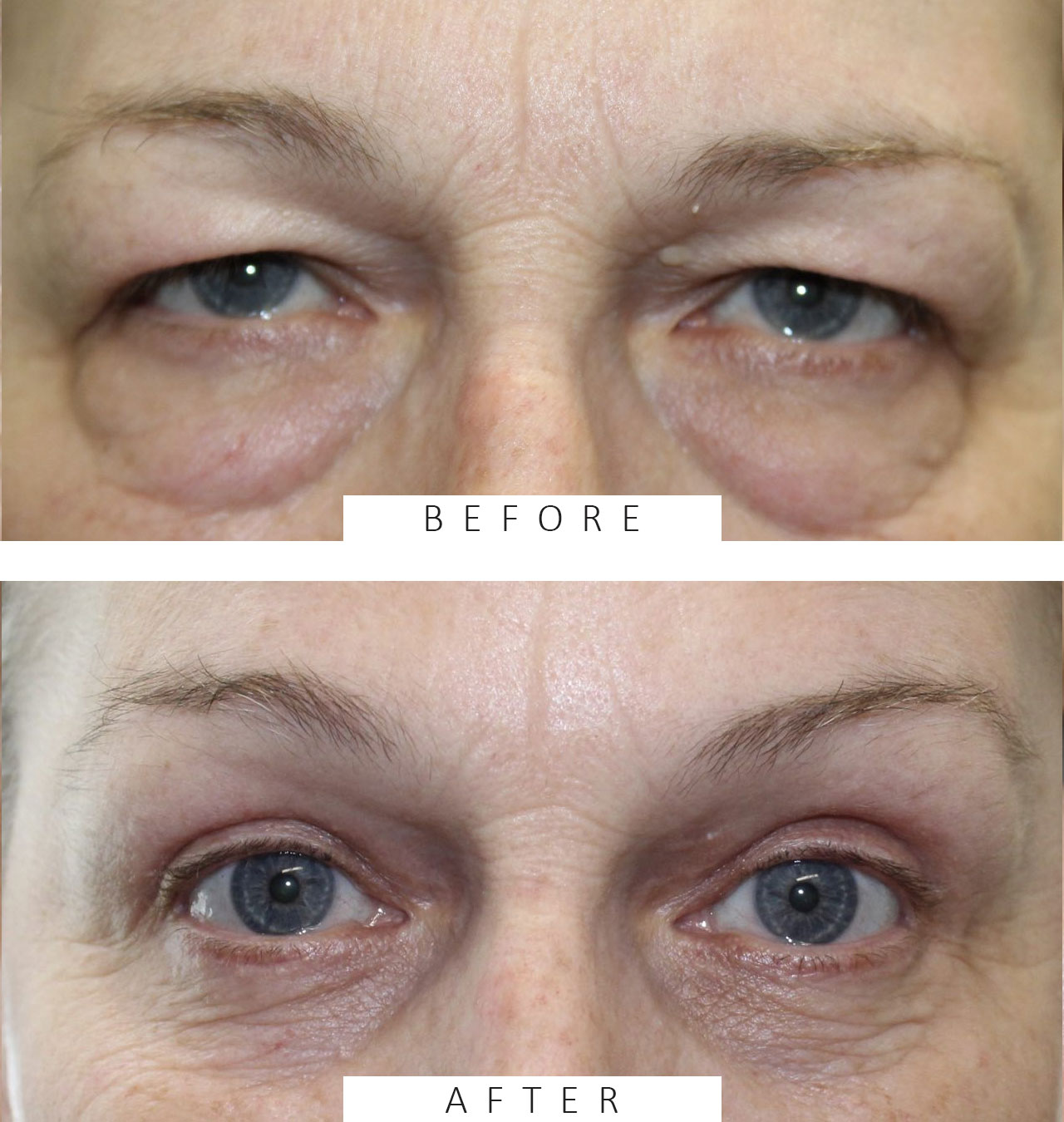 Upper & Lower Blepharoplasty