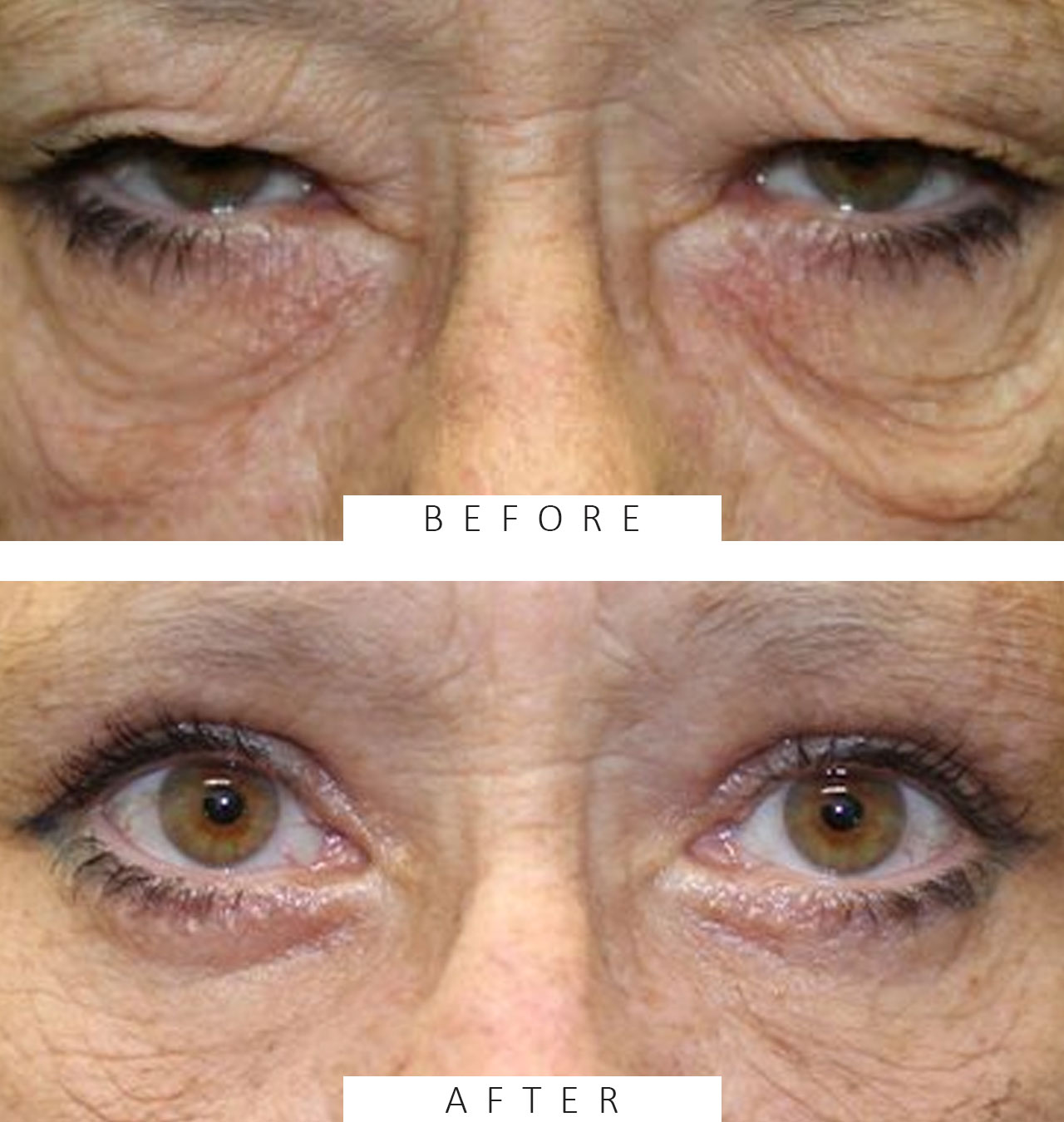 Upper & Lower Blepharoplasty & Direct Brow Ptosis Repair.
