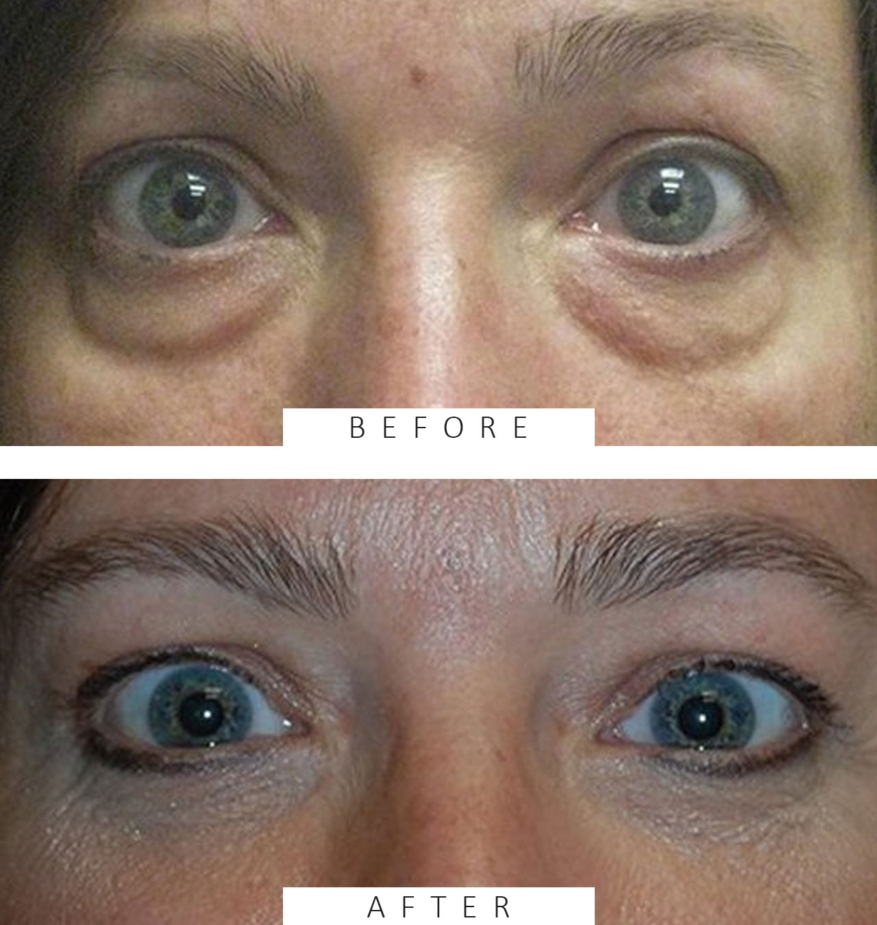 Lower Blepharoplasty