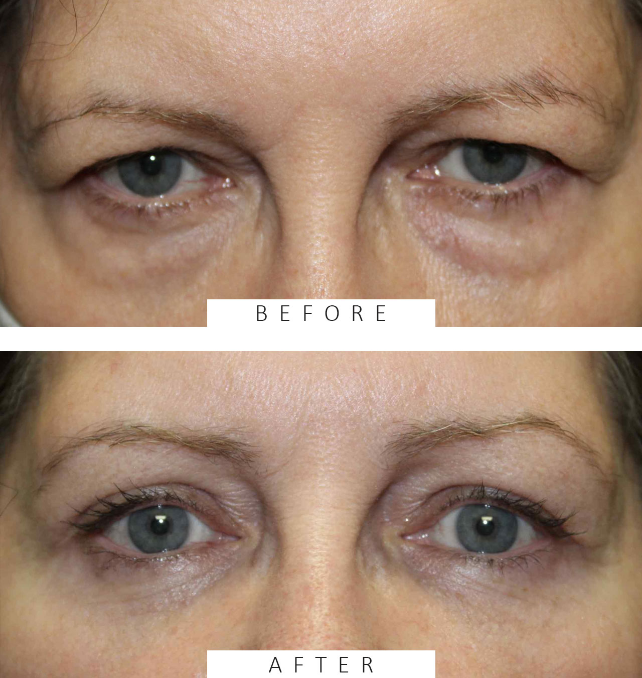 Upper & Lower Blepharoplasty