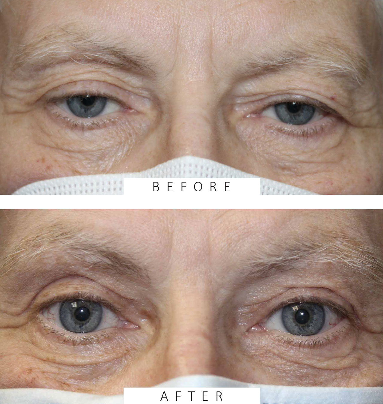 Upper Eyelid External Ptosis Repair