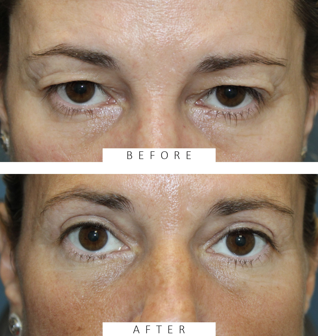 Bilateral upper blepharoplasty