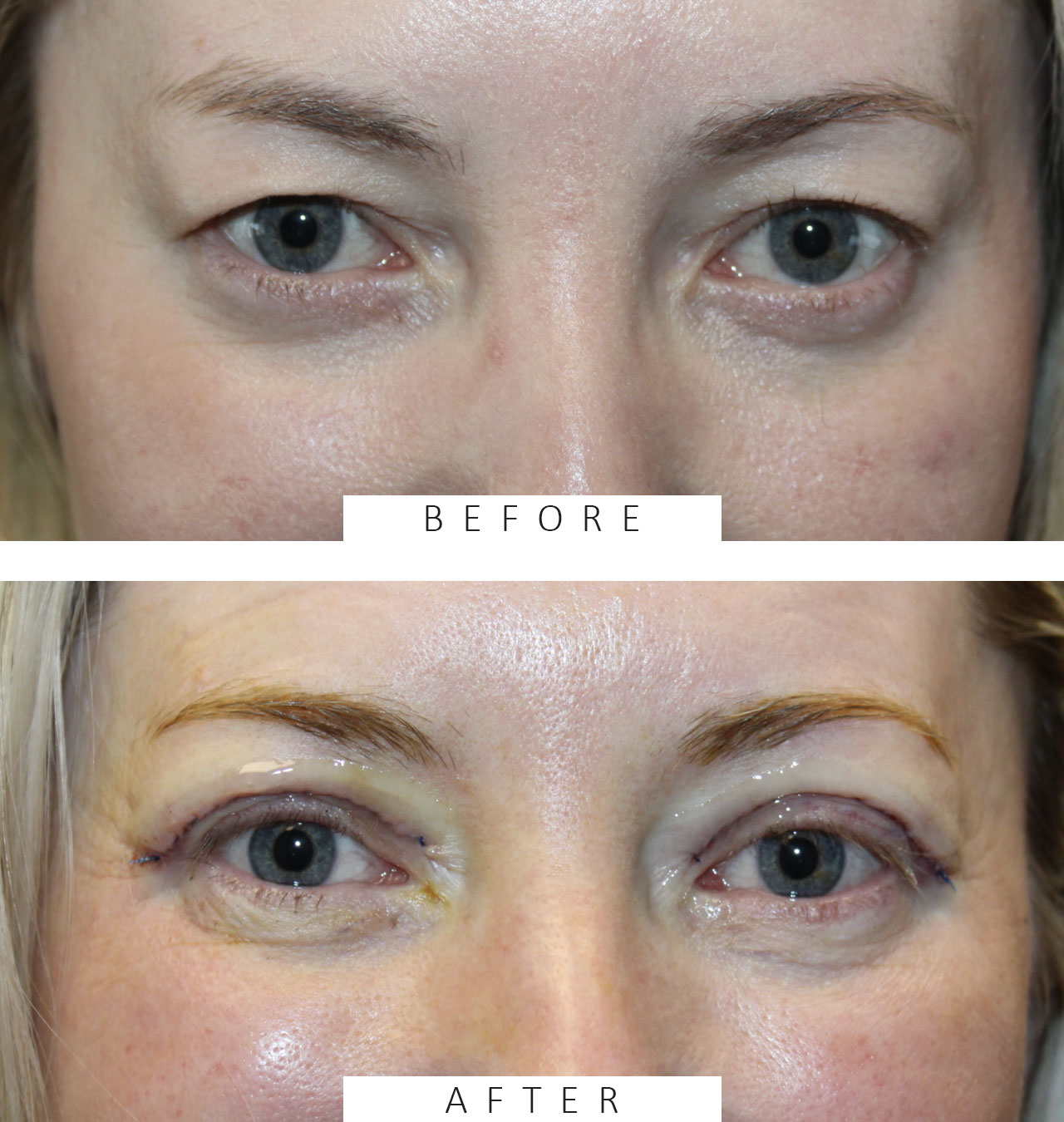 Before and immediately after upper blepharoplasty