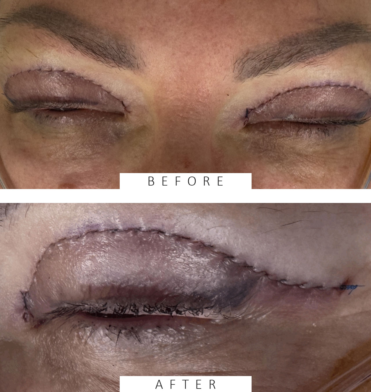 Suturing for Upper Blepharoplasty