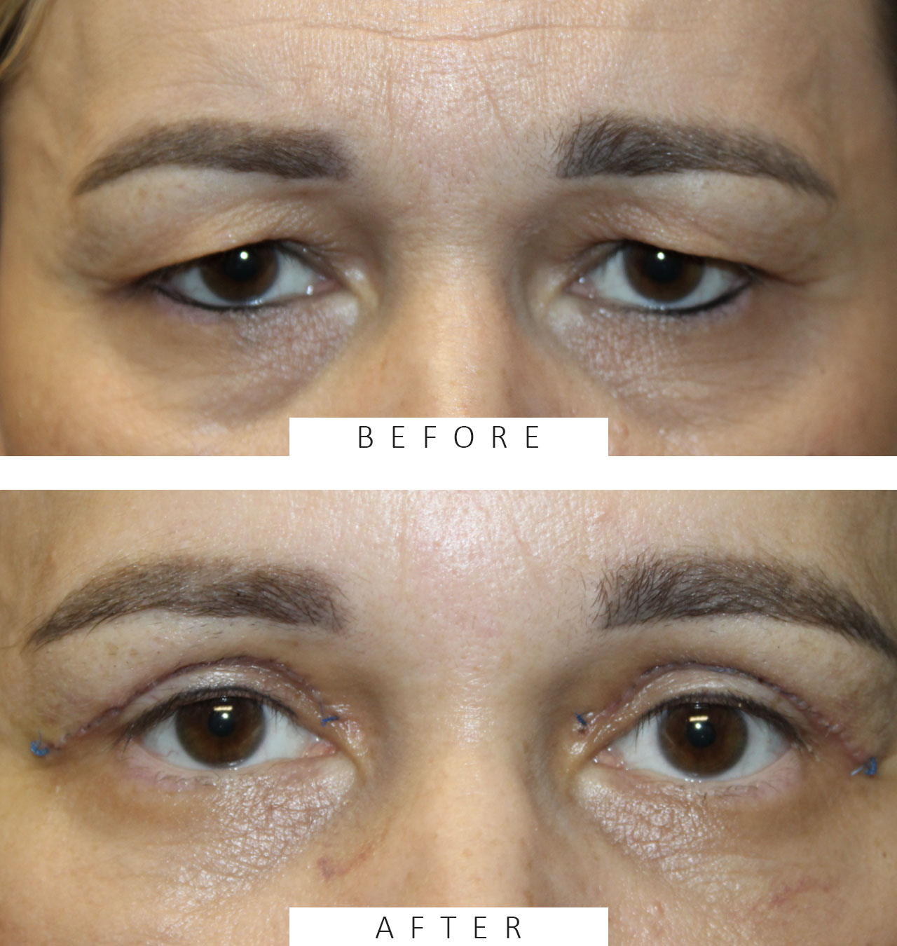 Upper Blepharoplasty