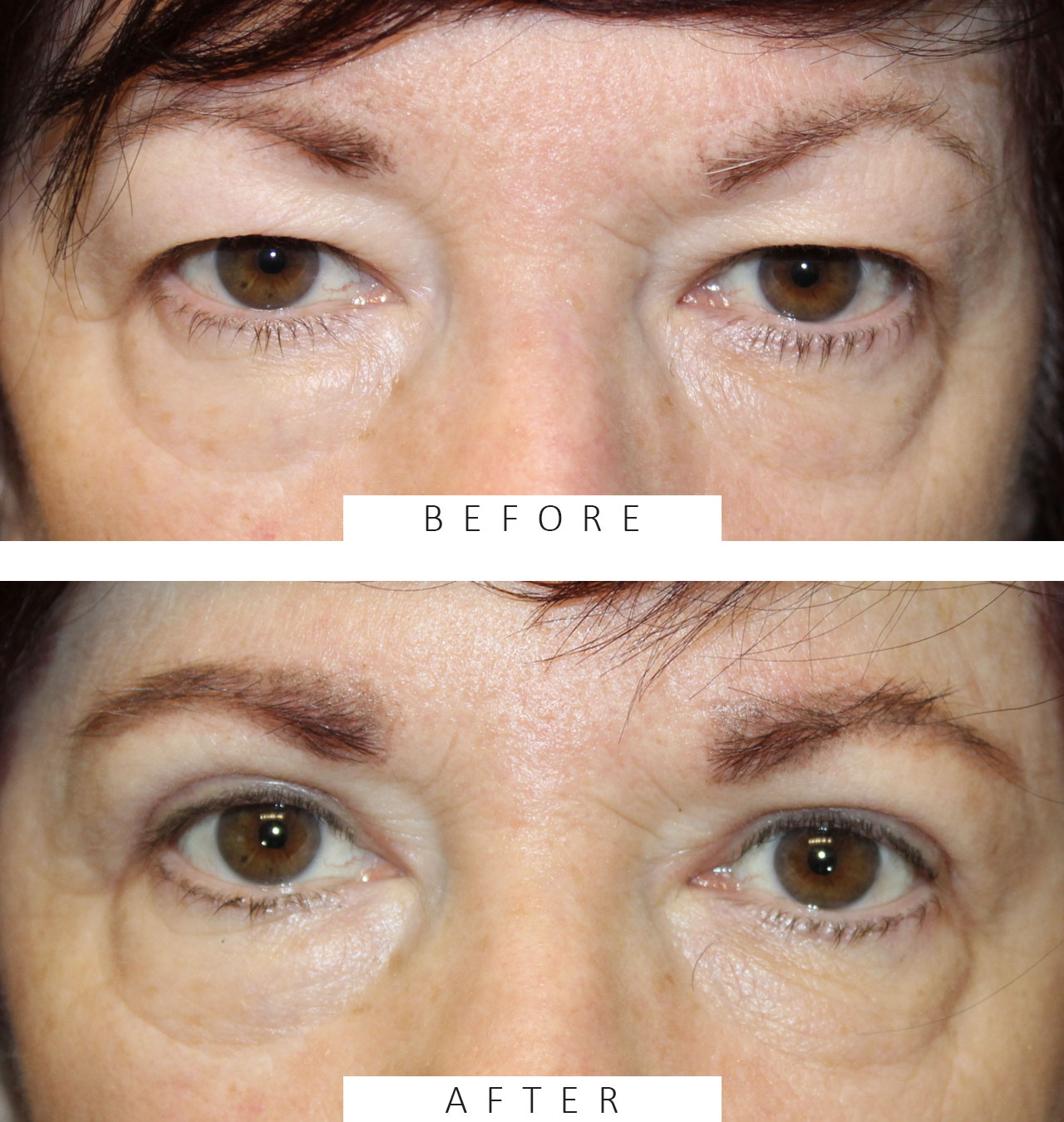 Upper Blepharoplasty