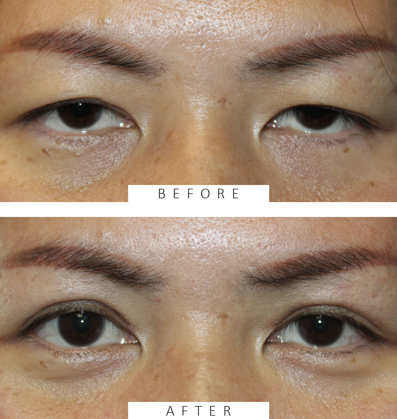Asian Eyelid Blepharoplasty