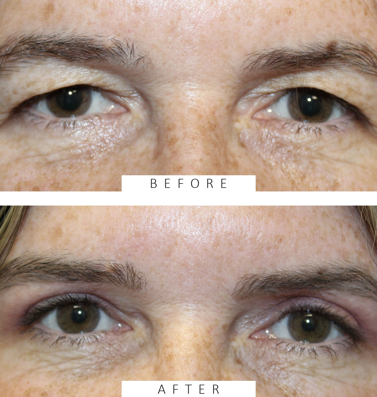 Upper Blepharoplasty