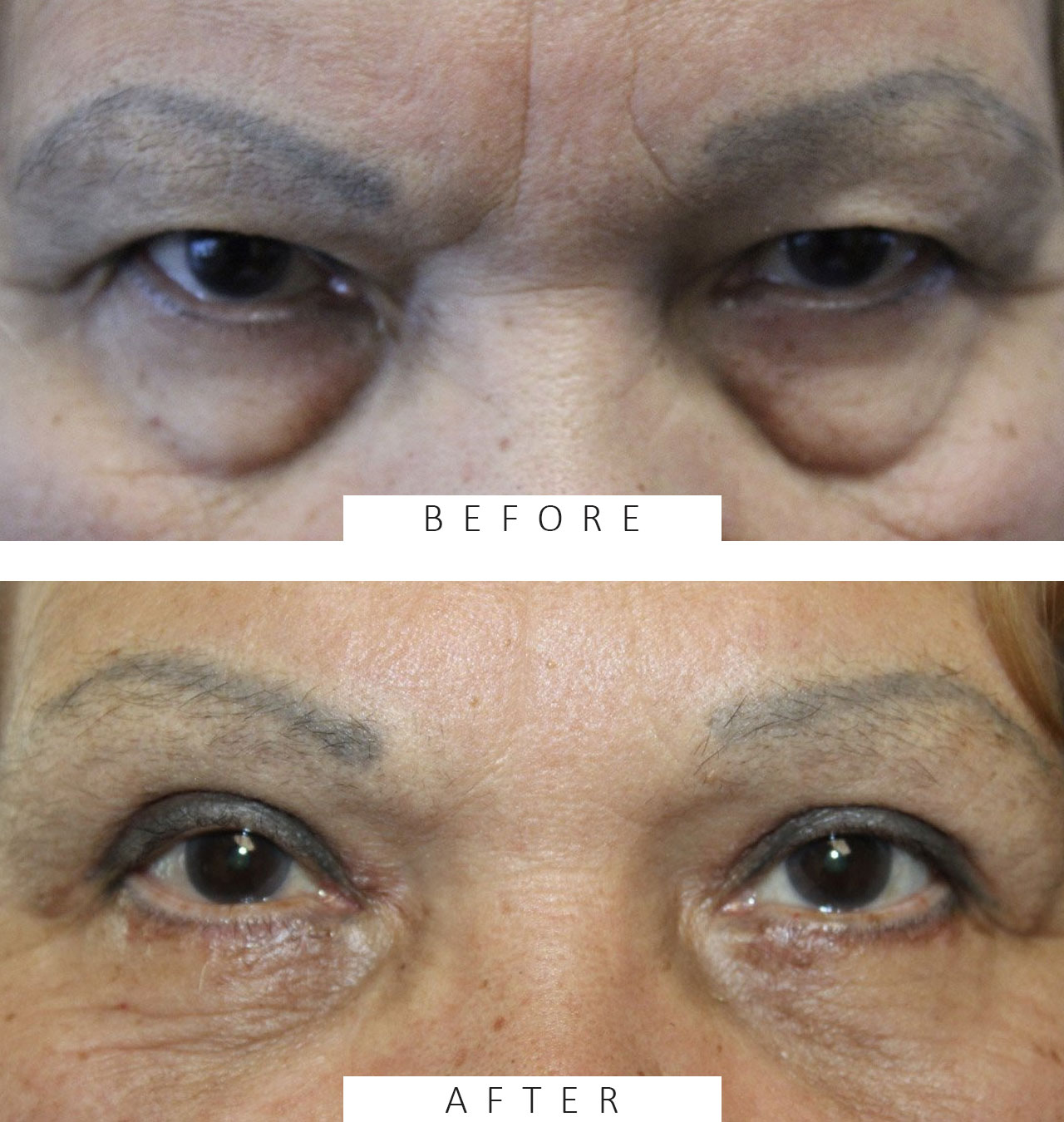 Upper and Lower Blepharoplasty