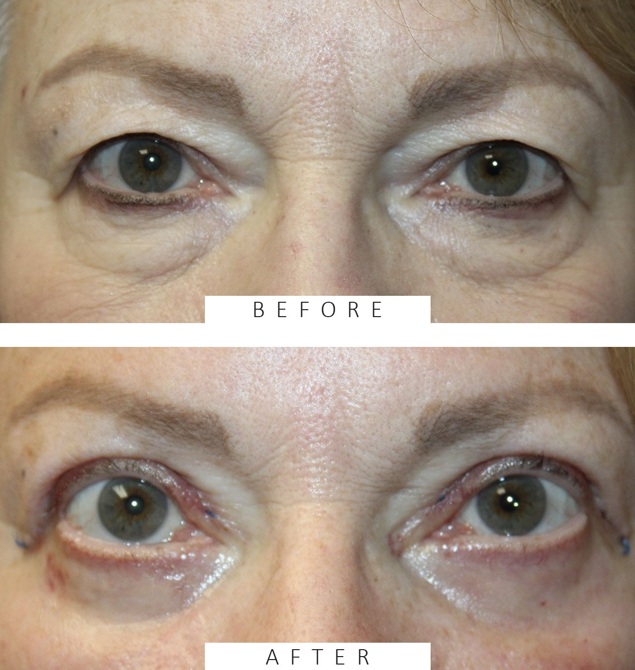 Upper and Lower Blepharoplasty with TCA peel