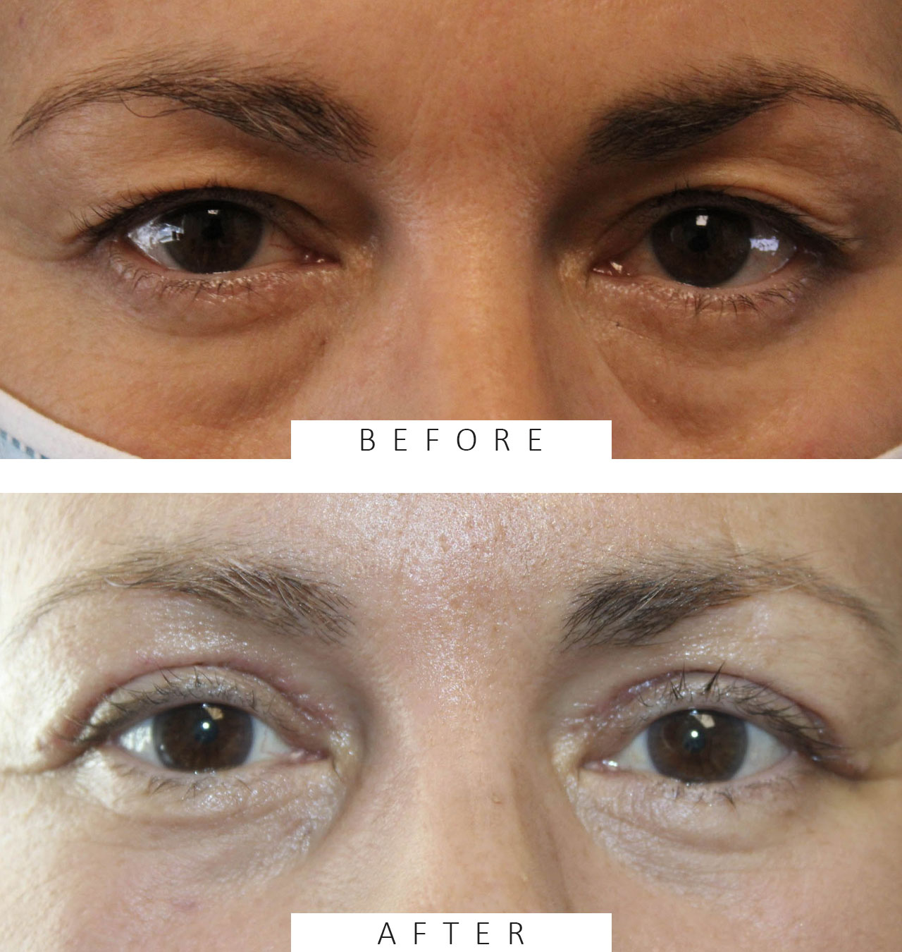 Upper and Lower Blepharoplasty