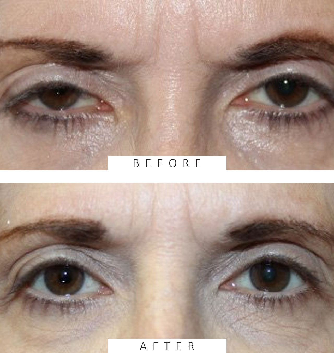Internal Ptosis repair on Right Eye.