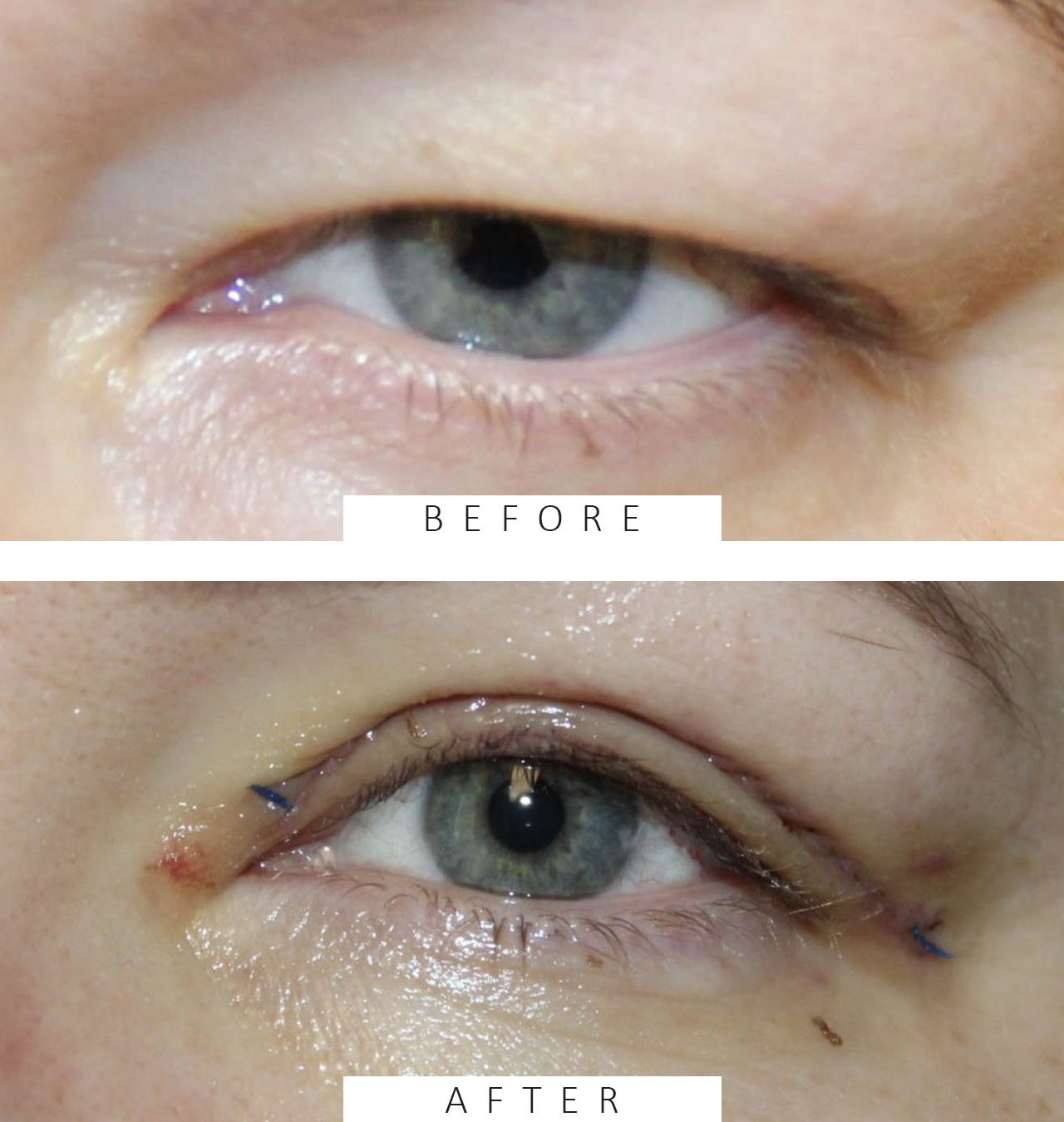 Upper Blepharoplasty