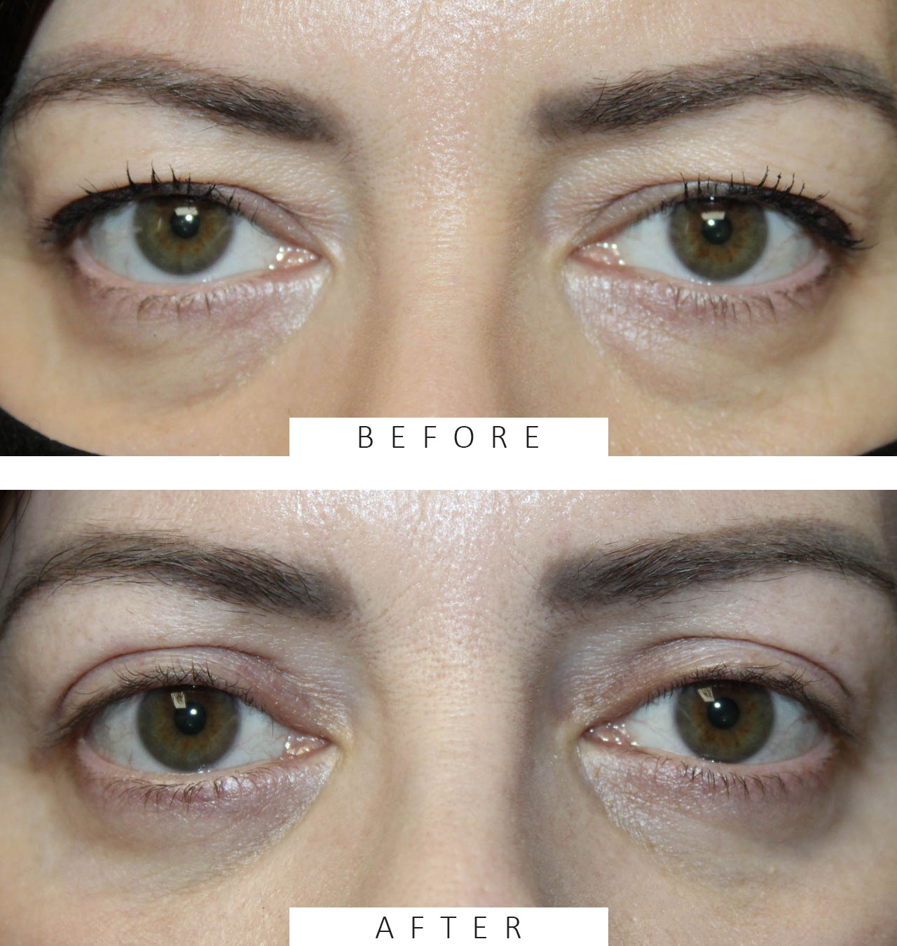 Upper & Lower Blepharoplasty with TCA peel