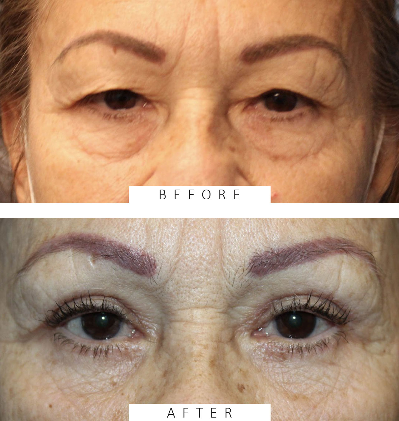 Upper & Lower Blepharoplasty with TCA peel
