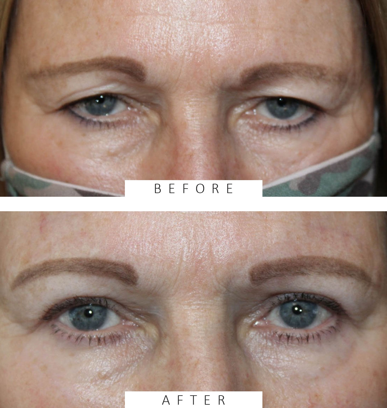 Upper Blepharoplasty and Brow Ptosis Repair