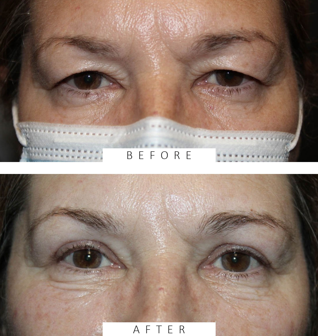 Upper Blepharoplasty