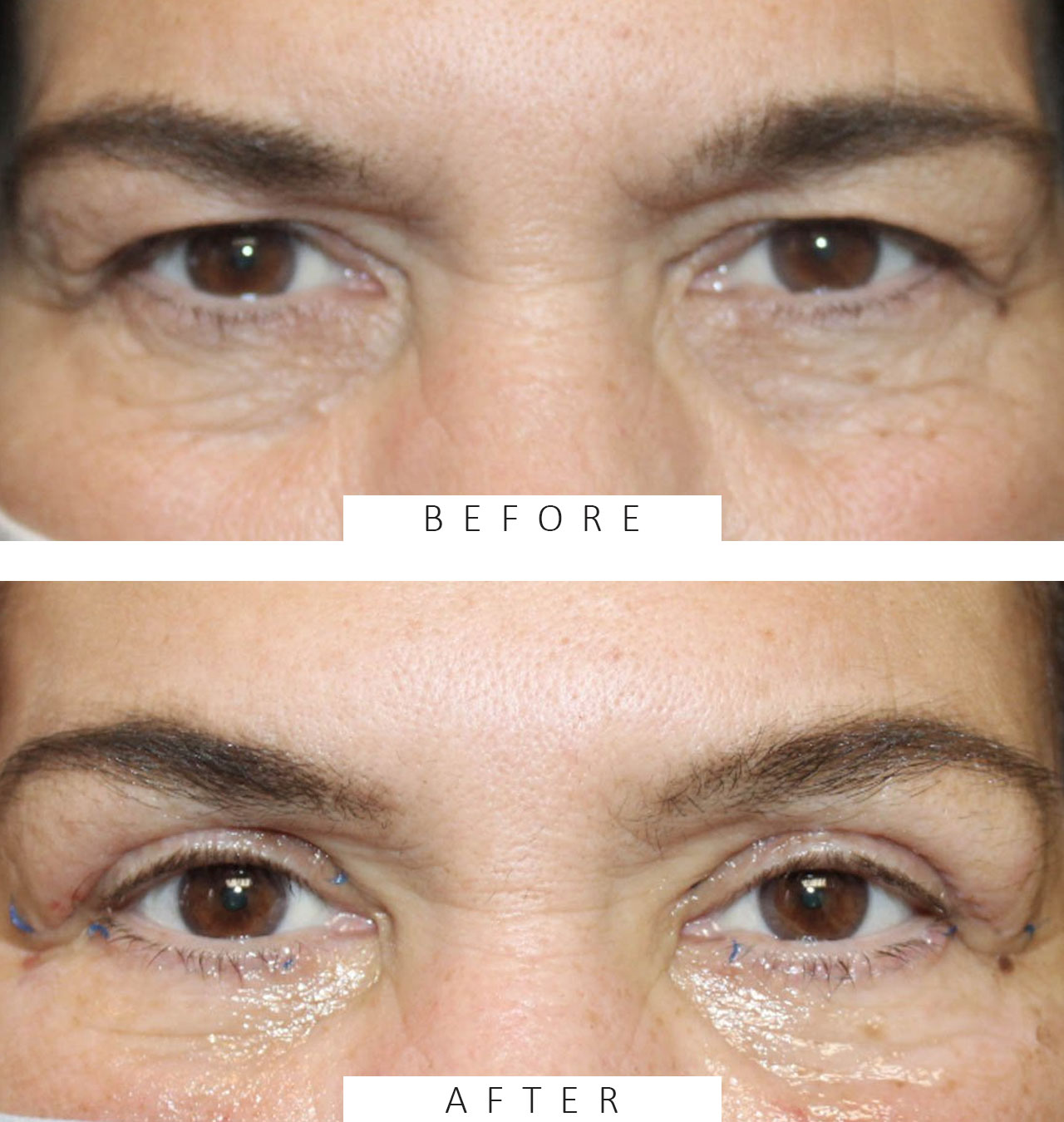 Upper & Lower Blepharoplasty with TCA peel