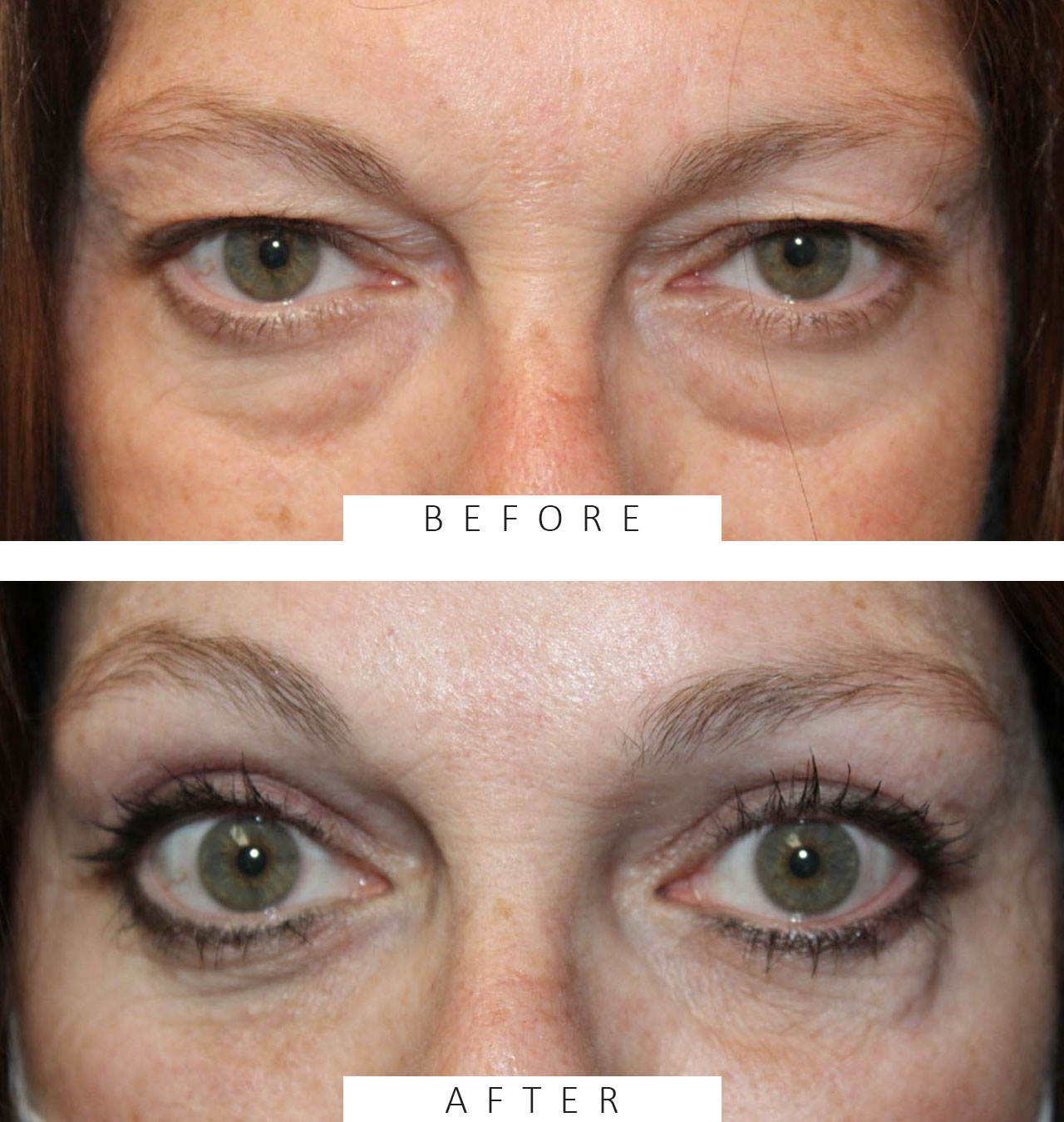 Upper & Lower Blepharoplasty