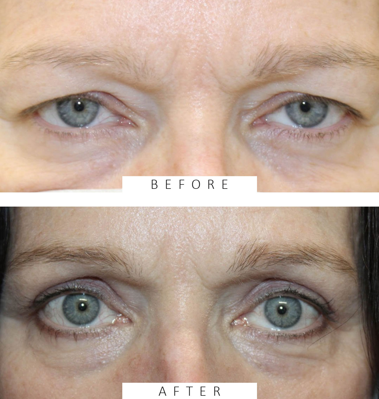 Upper Blepharoplasty