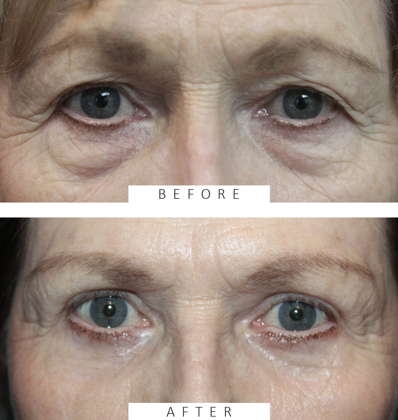 Upper & Lower Blepharoplasty with TCA peel and Brow Ptosis Repair