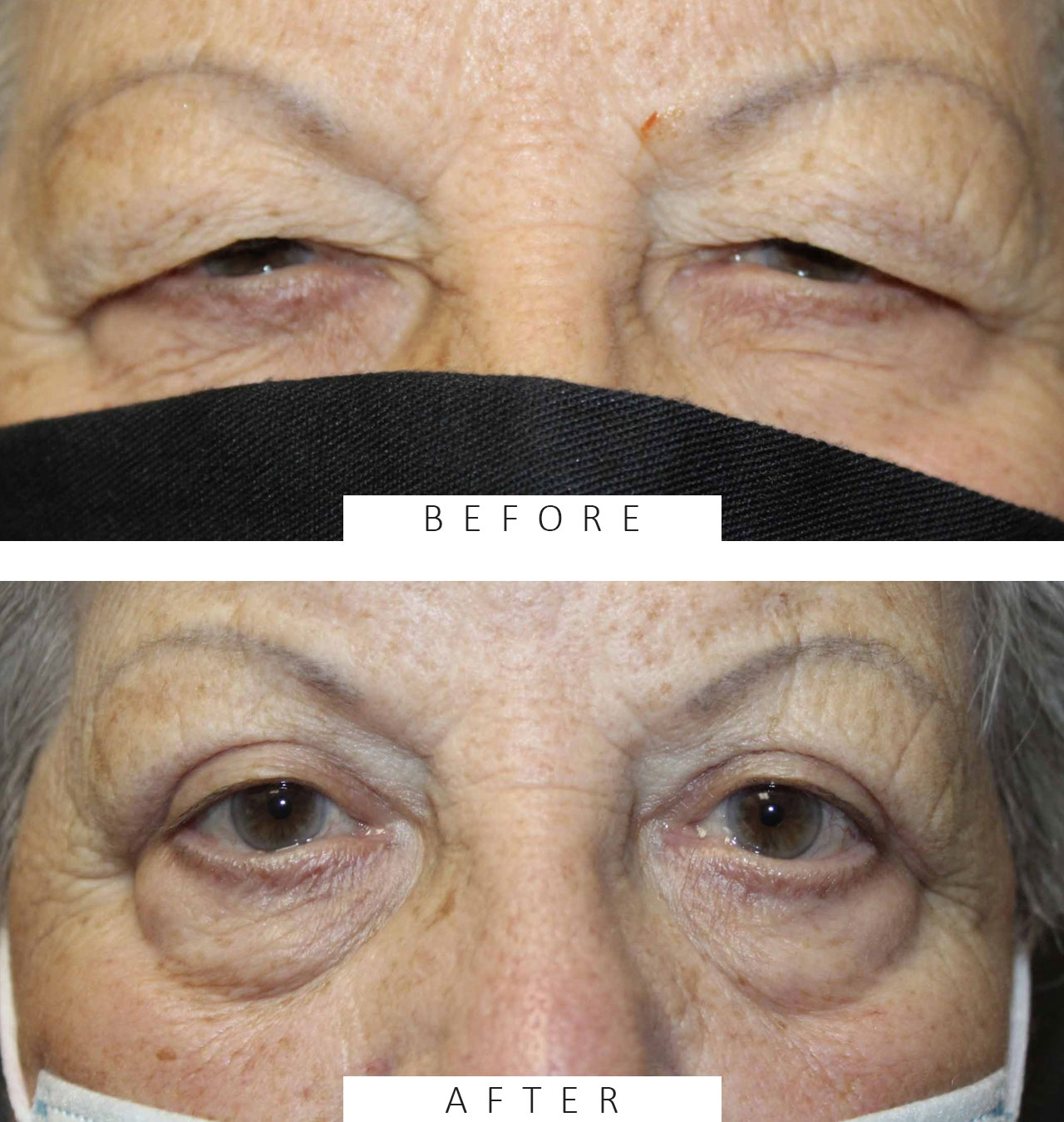 Upper Blepharoplasty