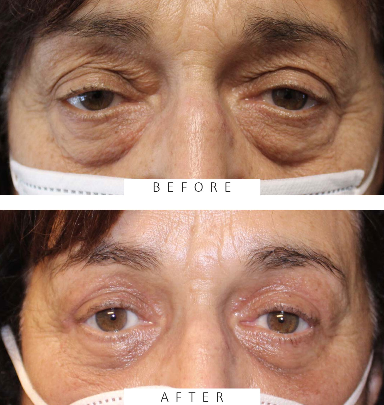 Upper & Lower Blepharoplasty with Upper Eyelid Ptosis Repair