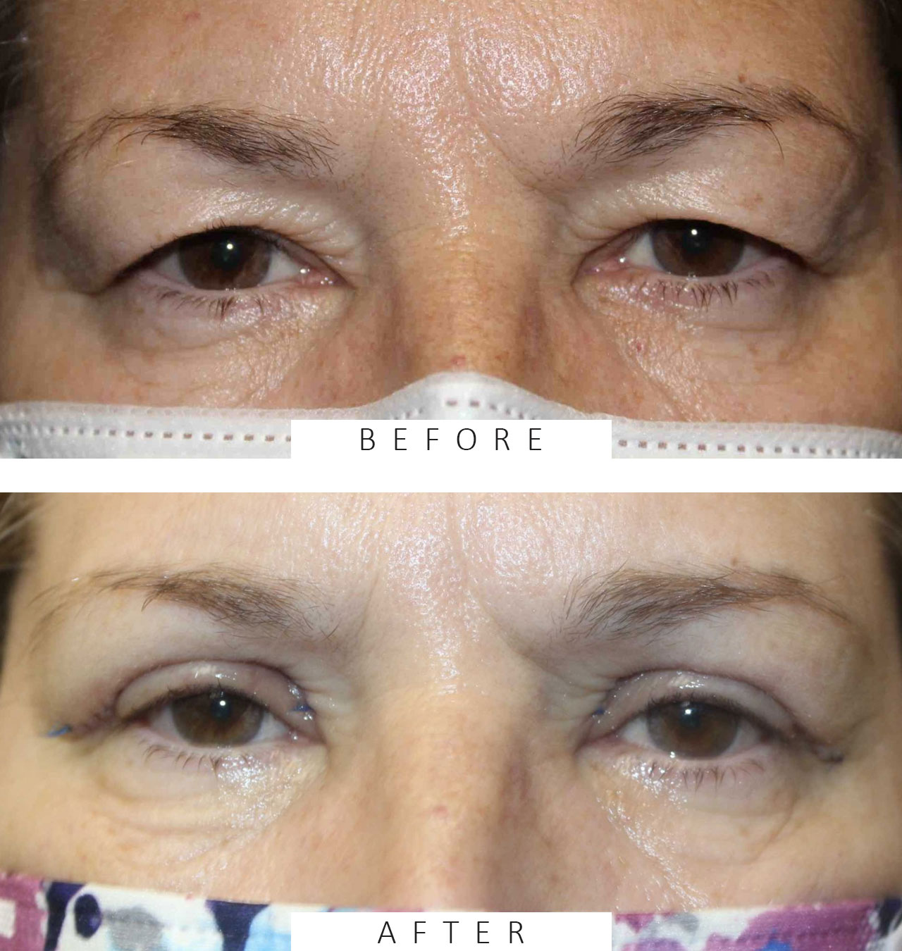 Upper Blepharoplasty after 1 week