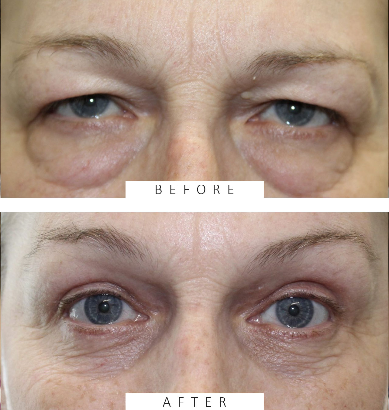 Upper & Lower Blepharoplasty